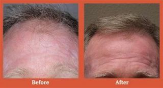 hair transplantation clinic henderson Vegas Valley Hair Restoration