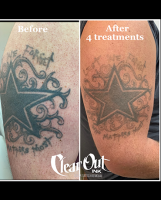 tattoo removal service henderson Clear Out Ink Laser Tattoo Removal